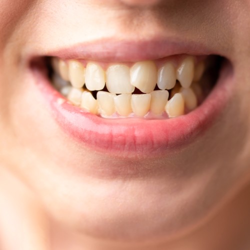 שיניים כלואות, איך טפלים בשיניים כלואות